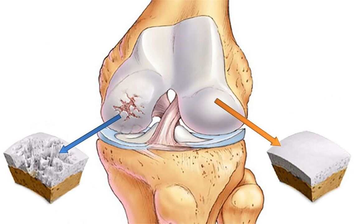 Destruction of the cartilage of the knee joint with gonarthrosis
