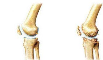 Symptoms of atrocious knee -based atrocisis