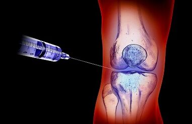 The treatment plan for the arthrosis of the knee joint