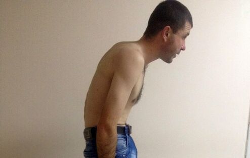 Ankylosing spondylitis can cause lower back pain over the years