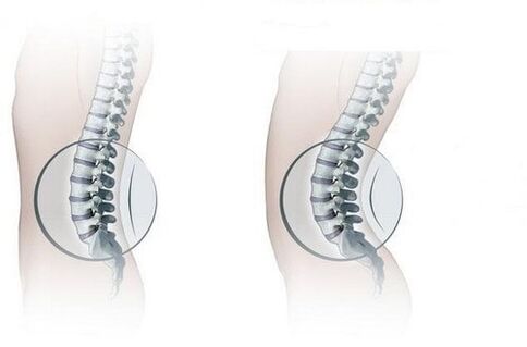 Normal spine and increased lumbar lordosis