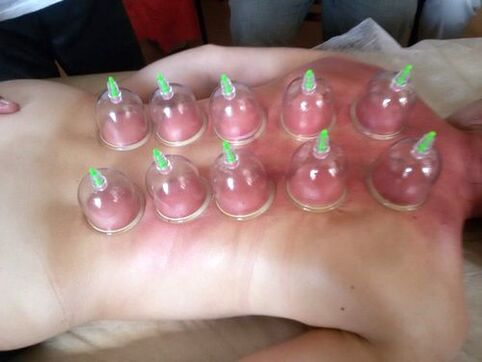 Vacuum cupping is a great way to treat low back pain at home