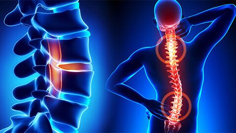 Spinal osteochondritis